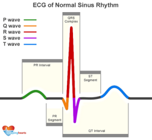 ecg_normal_sinus_rhythm